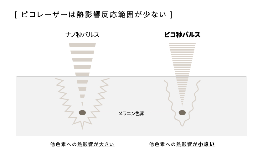 ピコレーザーは熱影響反応範囲が少ない