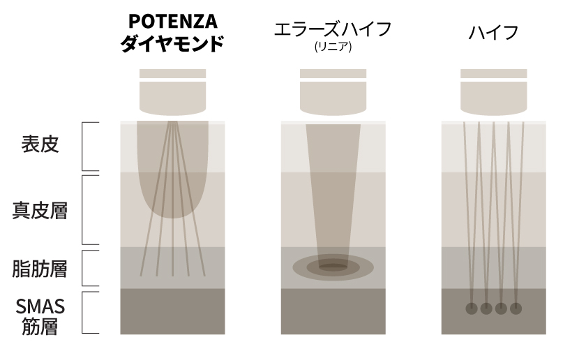 新チップ「POTENZAダイヤモンド」とハイフの照射比較