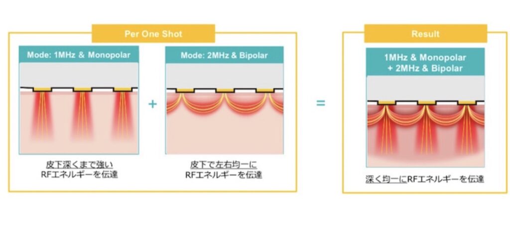 新チップ「POTENZAダイヤモンド」の照射イメージ