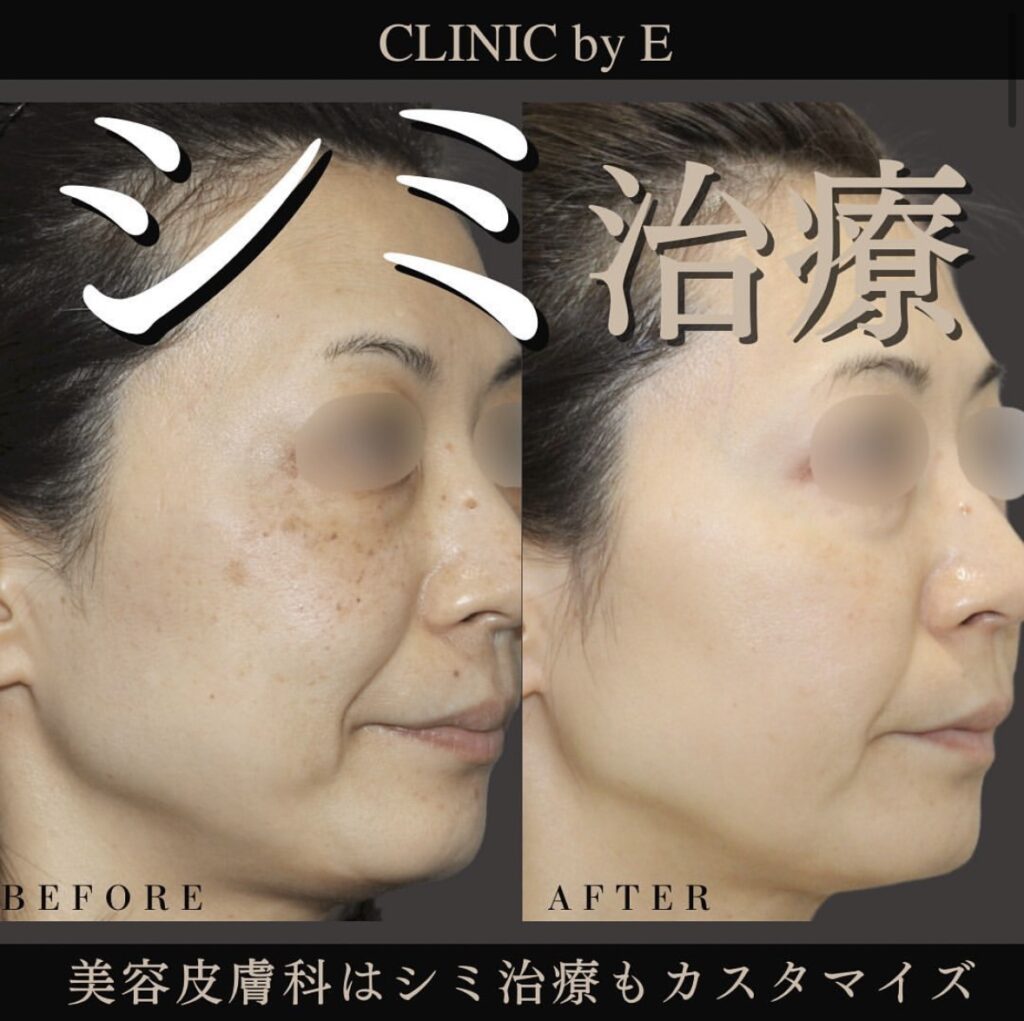 シミ治療
