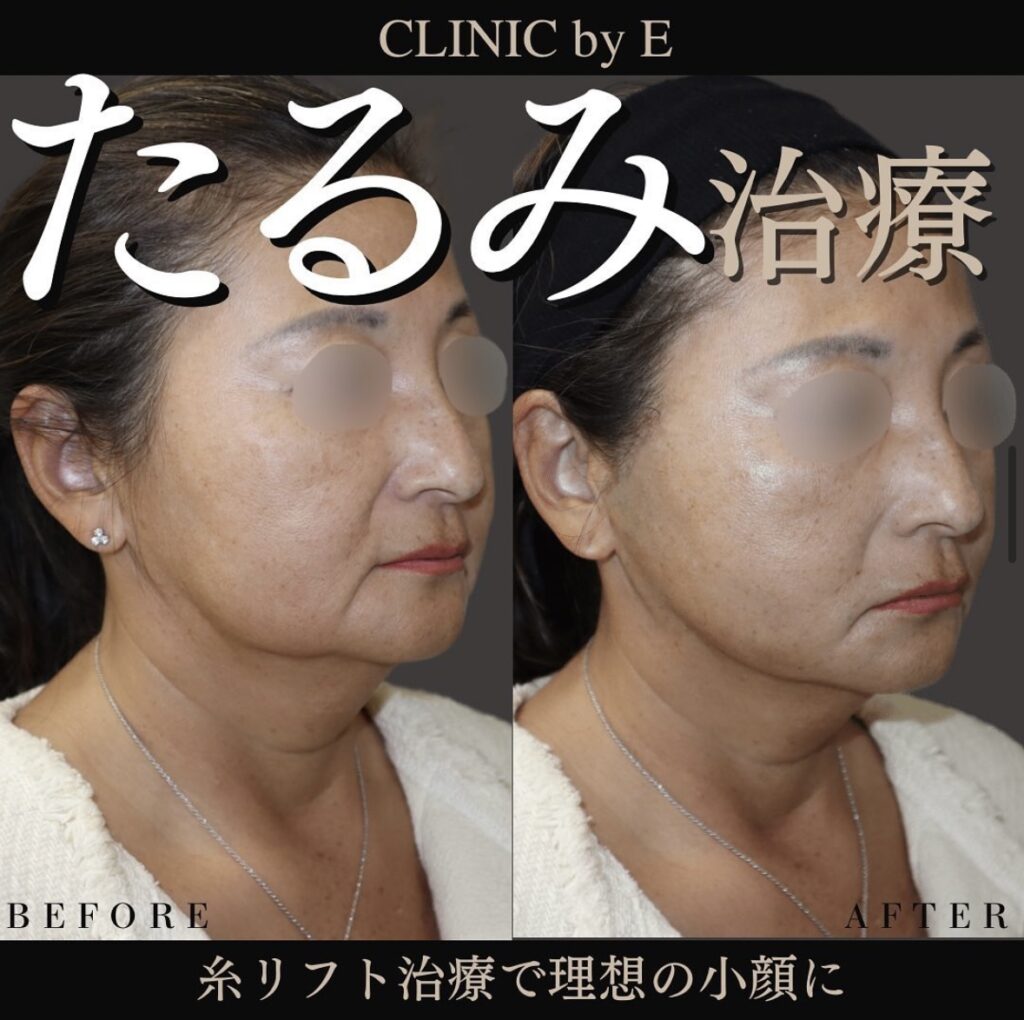 たるみ治療