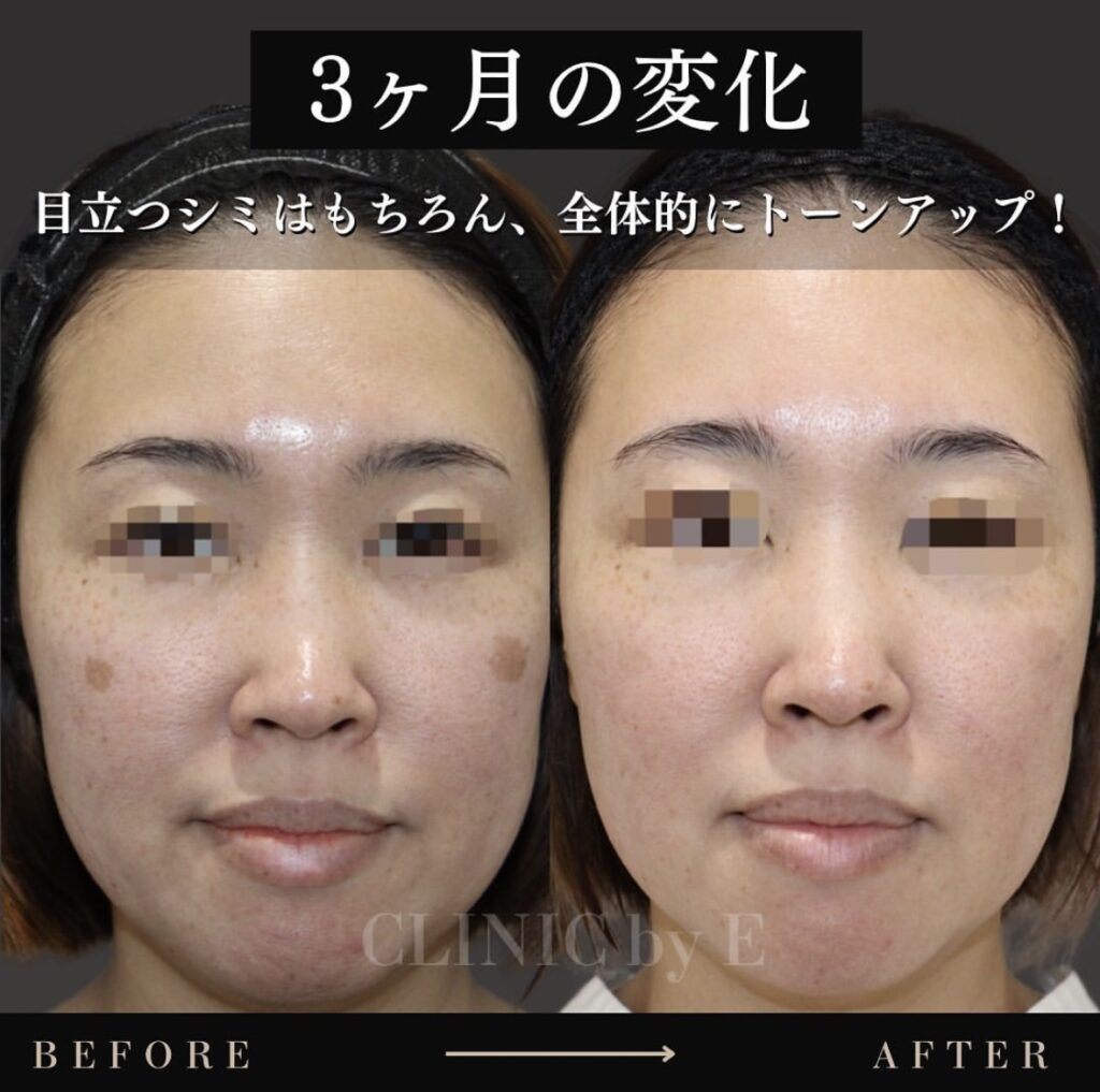 トラネキサム酸