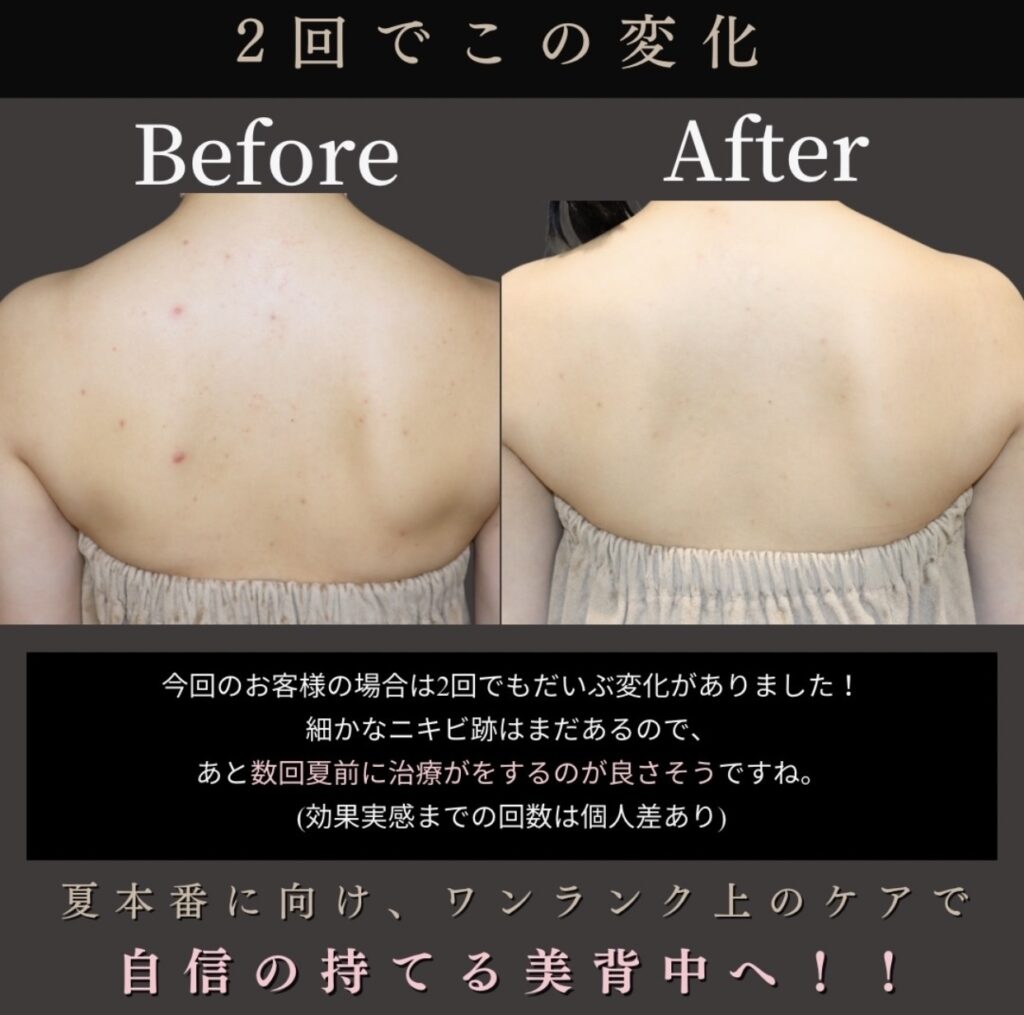 自身の持てる美背中