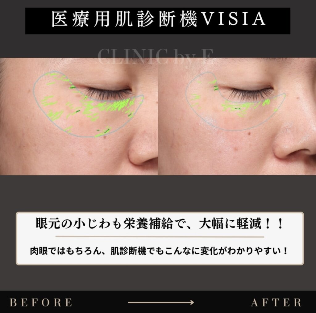 小じわ改善治療