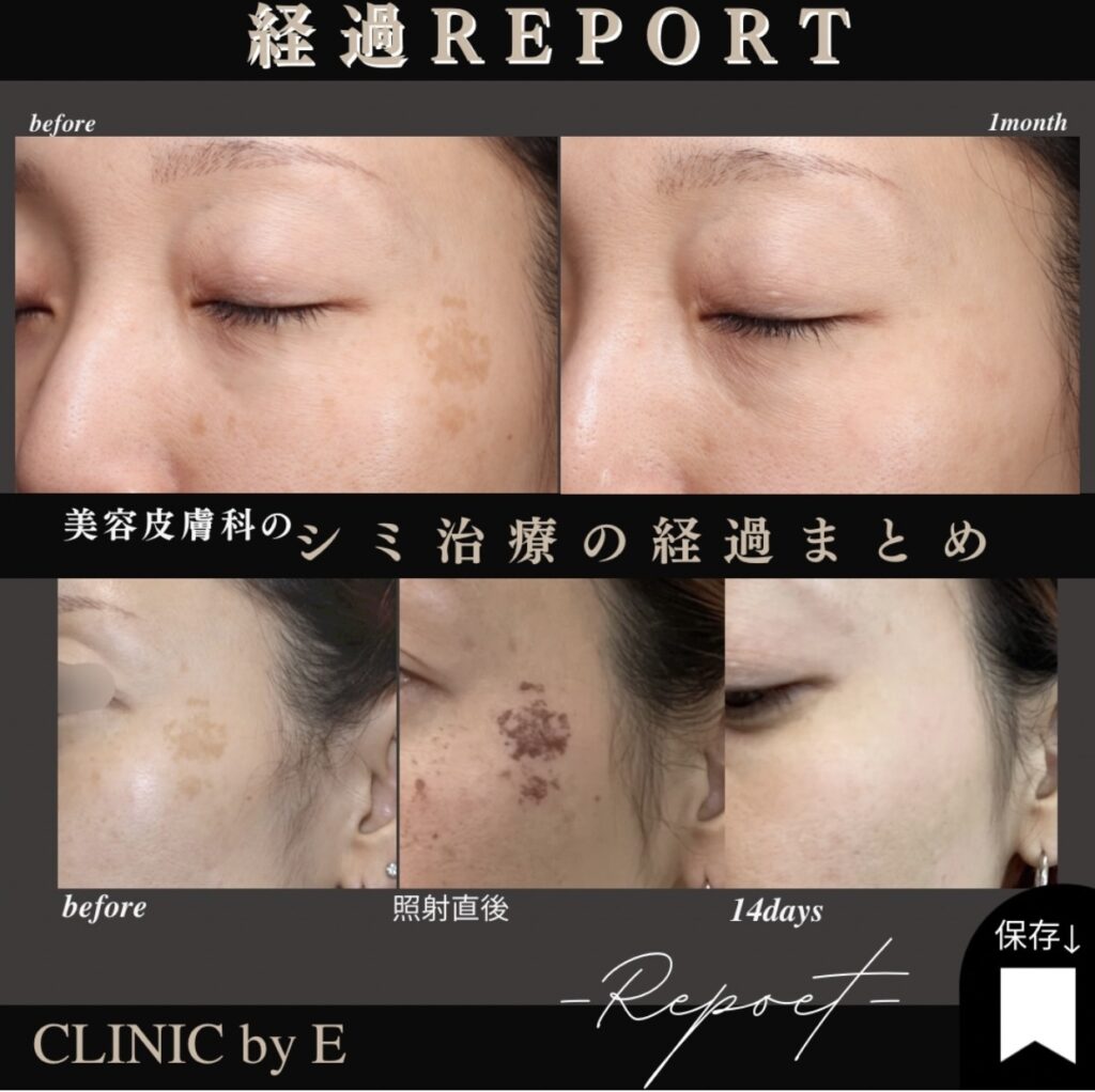 シミ治療経過