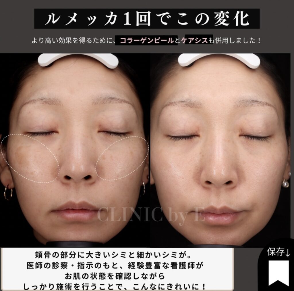 ルメッカ1回での効果