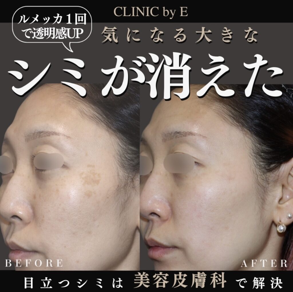 シミ治療