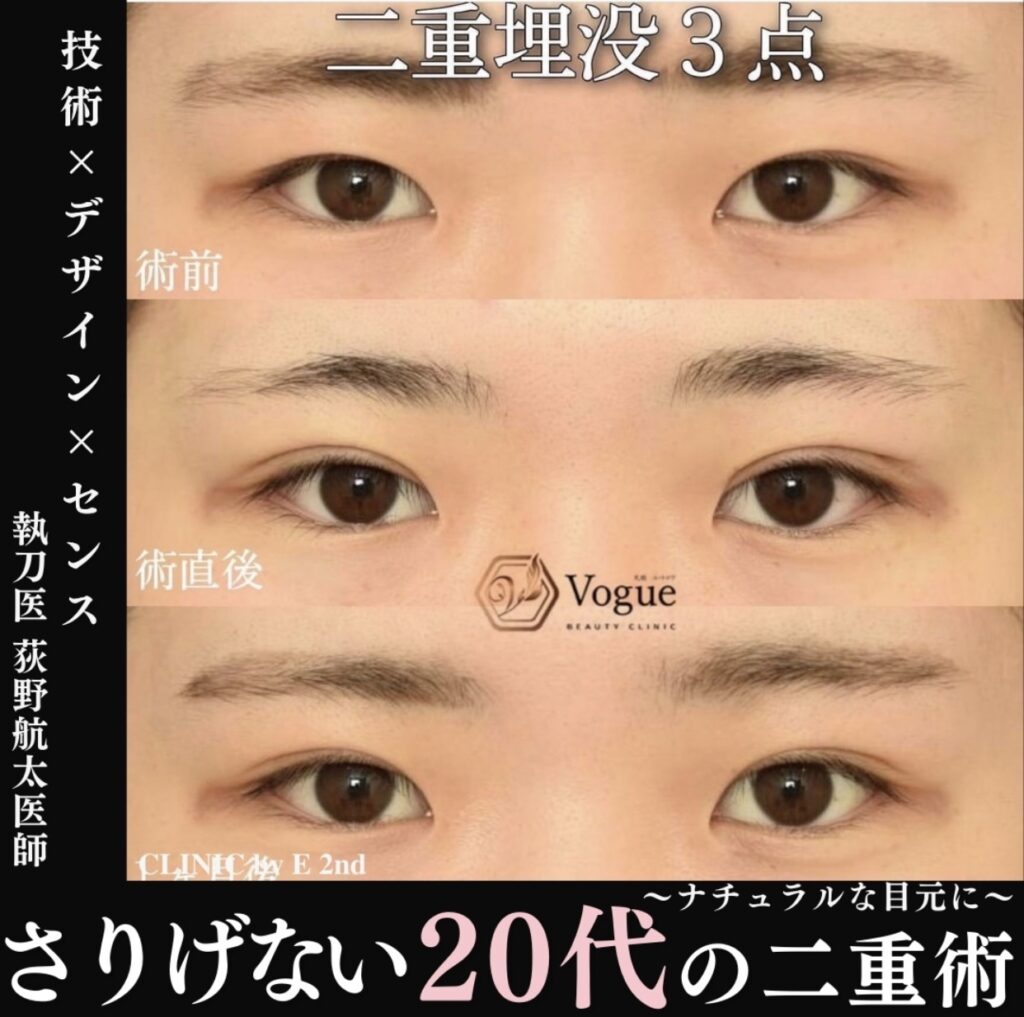 20代の二重