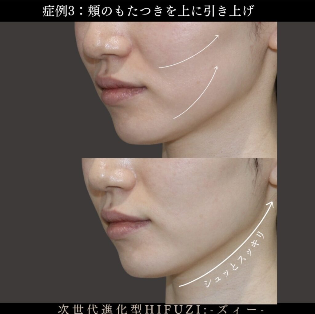 フェイスライン