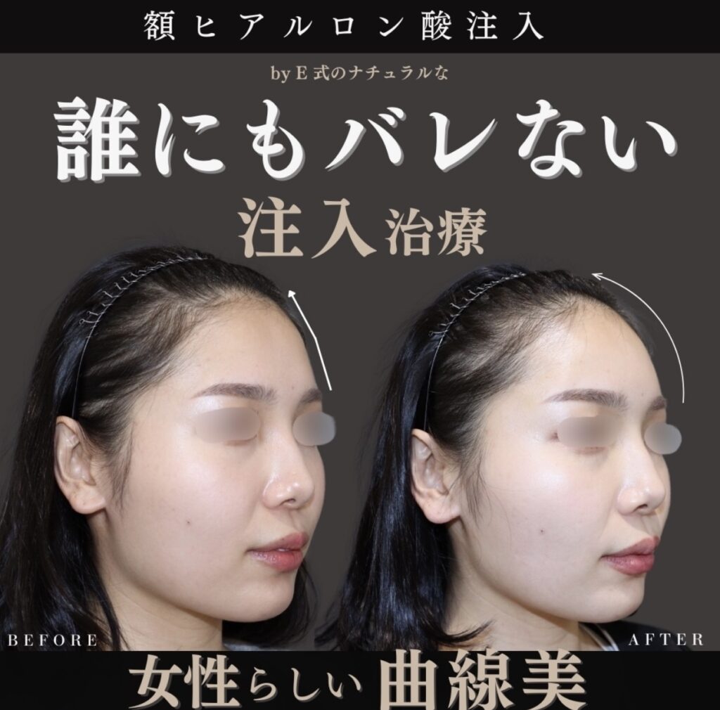 ばれない注入治療