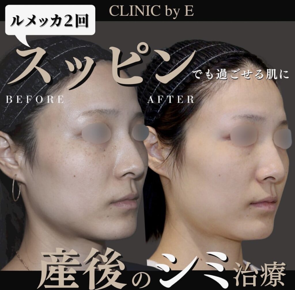 ハイドロキノン