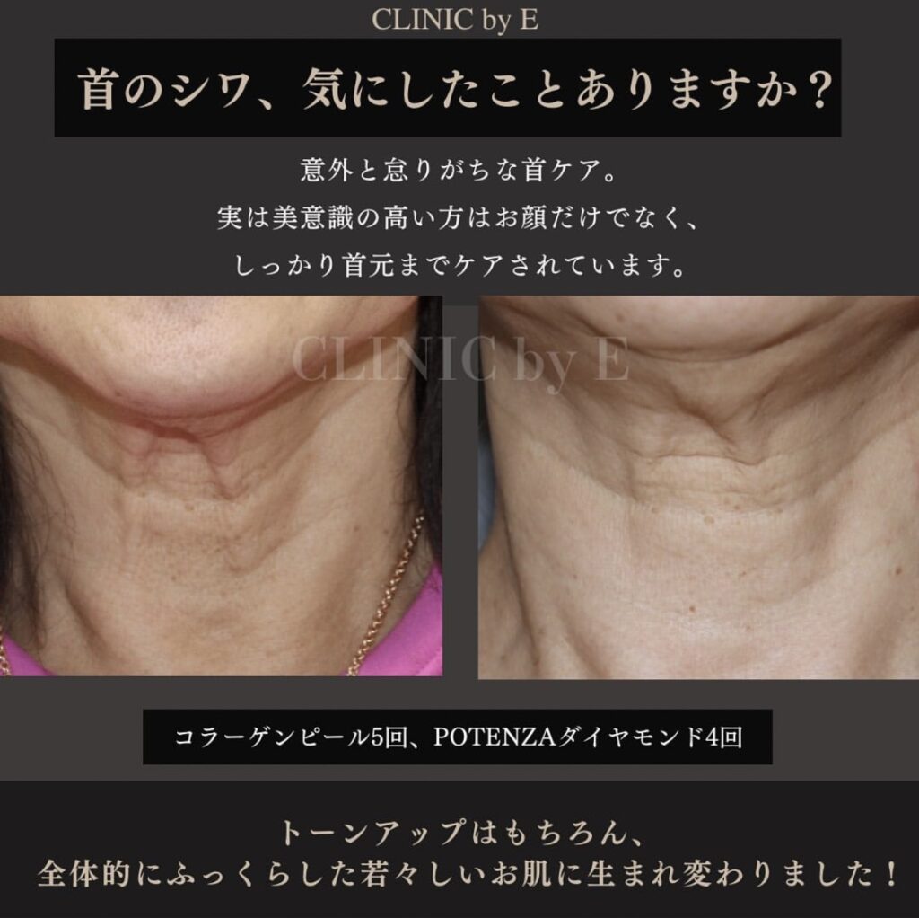 マッサージピール