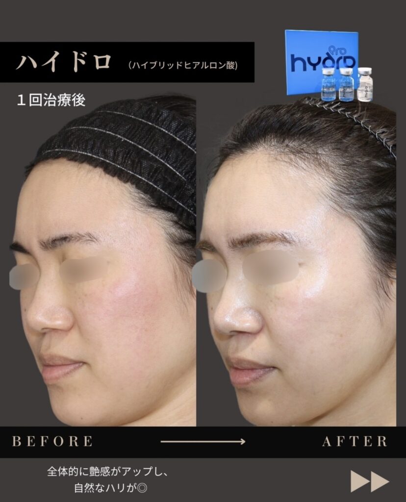 架橋ヒアルロン酸