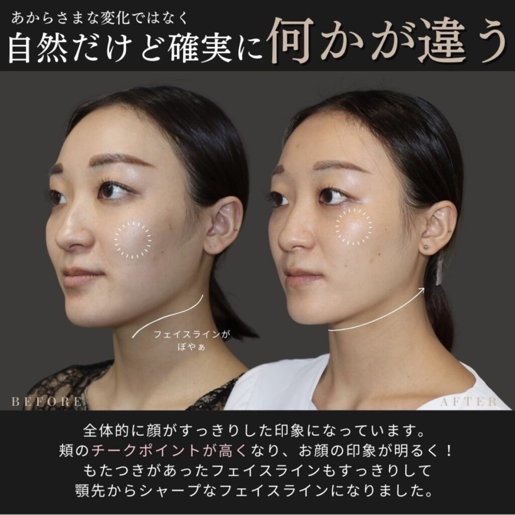 ショッピングリフト