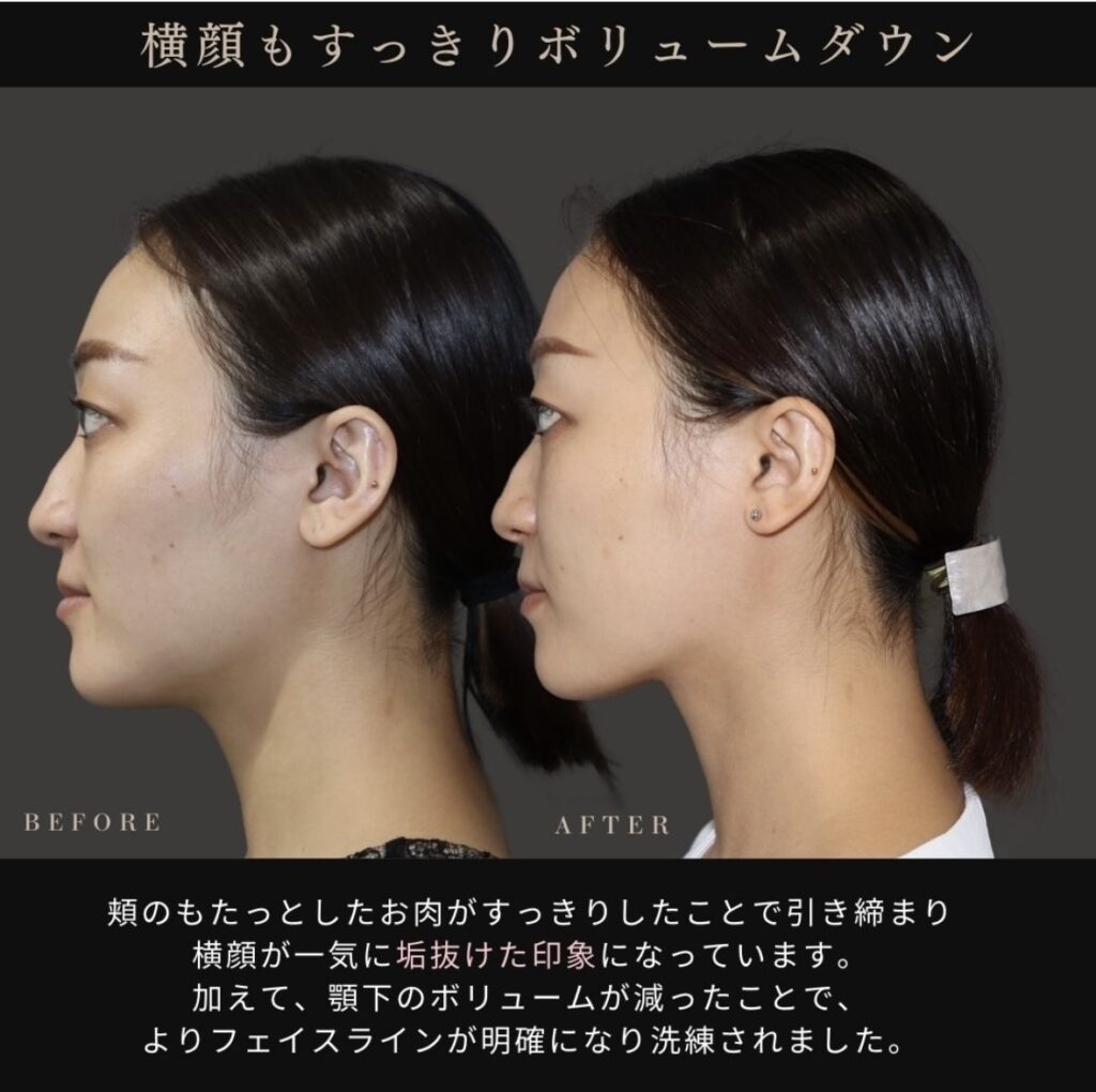 うる艶コラーゲンリフト