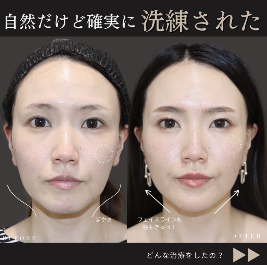 ナチュラル輪郭形成