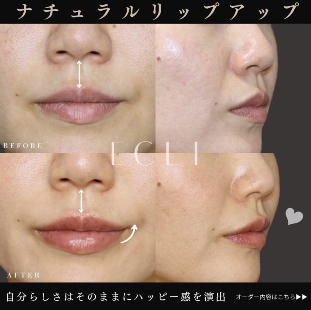 ナチュラルリップアップ