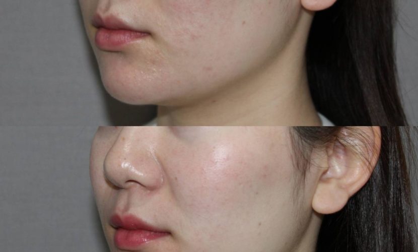 顎下をココシェイプで週1回3回施術の症例経過