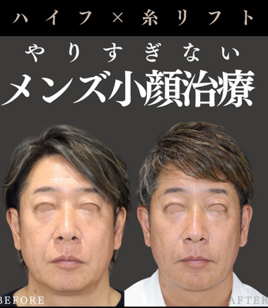 【やりすぎない！メンズ小顔治療】